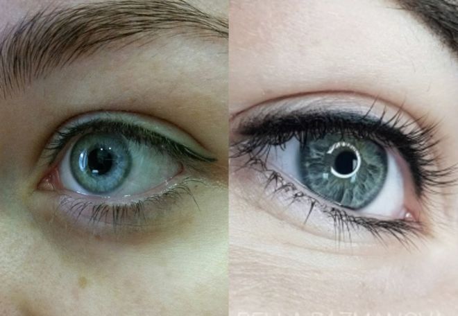 плюсы и минусы процедуры межресничка плюсы и минусы процедуры межресничка