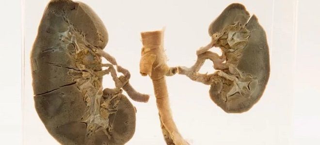 пороки развития почек пороки развития почек