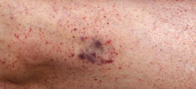 появляются синяки без причины на ногах появляются синяки без причины на ногах