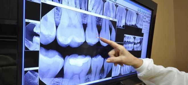 рентген зуба рентген зуба