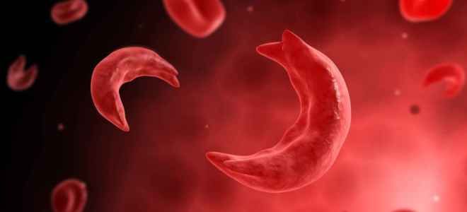 Серповидно клеточная анемия что это такое Серповидно клеточная анемия что это такое