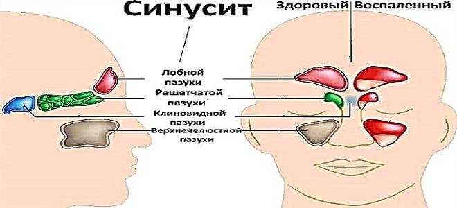 спрей для лечения синусита спрей для лечения синусита
