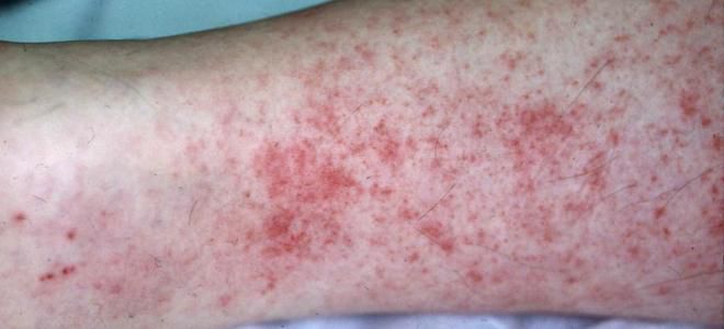 Сыпь при сыпном тифе раз Сыпь при сыпном тифе раз