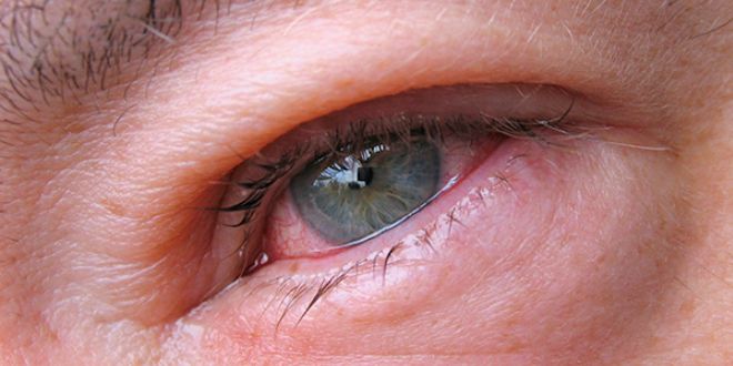 трихинеллез осложнения трихинеллез осложнения