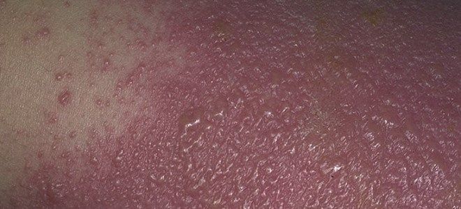 аллергический буллезный дерматит аллергический буллезный дерматит