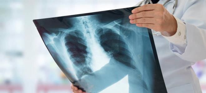 диагностика пневмонии диагностика пневмонии