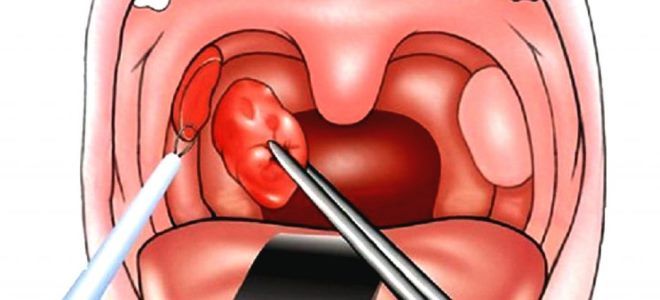 лечение тонзиллита лечение тонзиллита