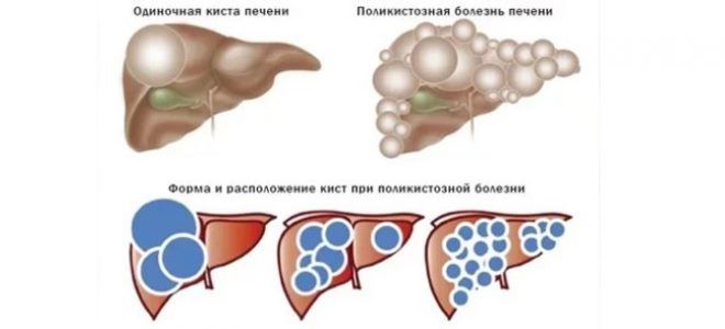 множественные кисты печени множественные кисты печени