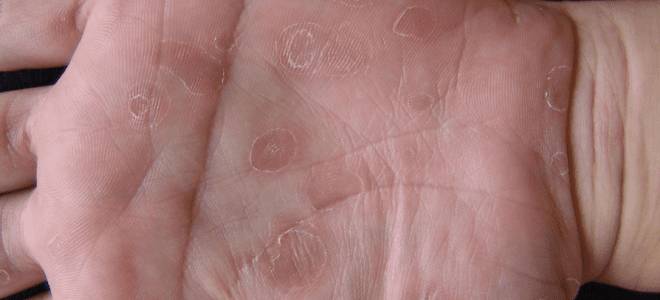 начальная стадия сифилиса начальная стадия сифилиса