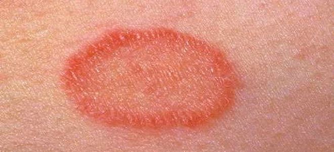 шелушащиеся пятна на коже шелушащиеся пятна на коже