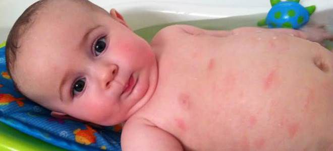 амоксиклав побочные действия амоксиклав побочные действия