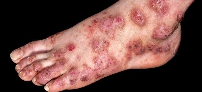 контактный буллезный дерматит контактный буллезный дерматит