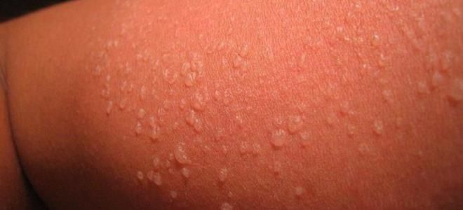 фототоксический дерматит фототоксический дерматит