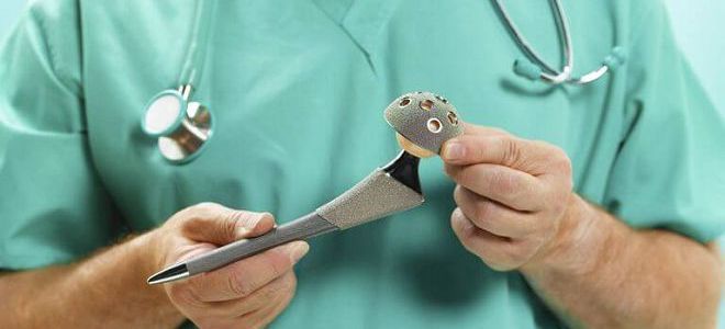 коксартроз тазобедренного сустава операция коксартроз тазобедренного сустава операция