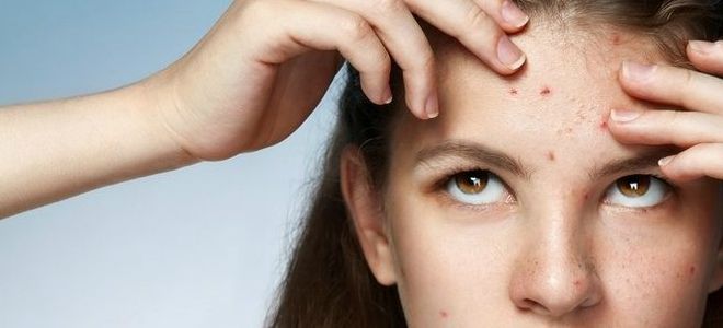 маска из дрожжей для лица от прыщей маска из дрожжей для лица от прыщей