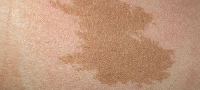 пигментные пятна на теле пигментные пятна на теле