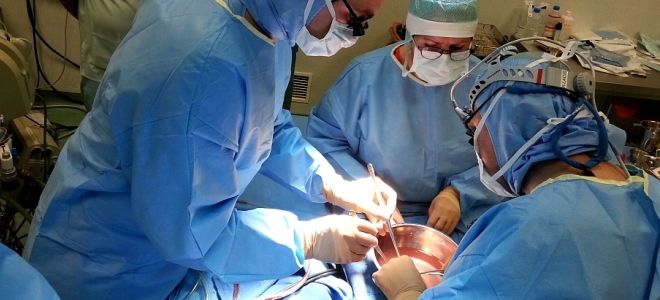 удаление кисты печени удаление кисты печени