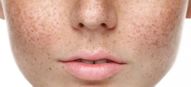 дрожжевая маска от пигментных пятен дрожжевая маска от пигментных пятен