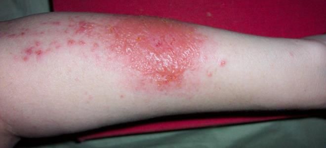 температурный дерматит температурный дерматит