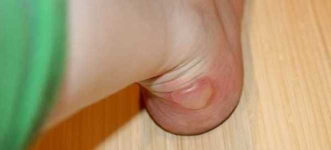 механический дерматит механический дерматит