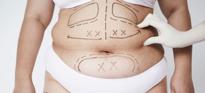пластика живота