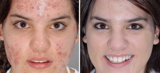 после пилинга тса 1